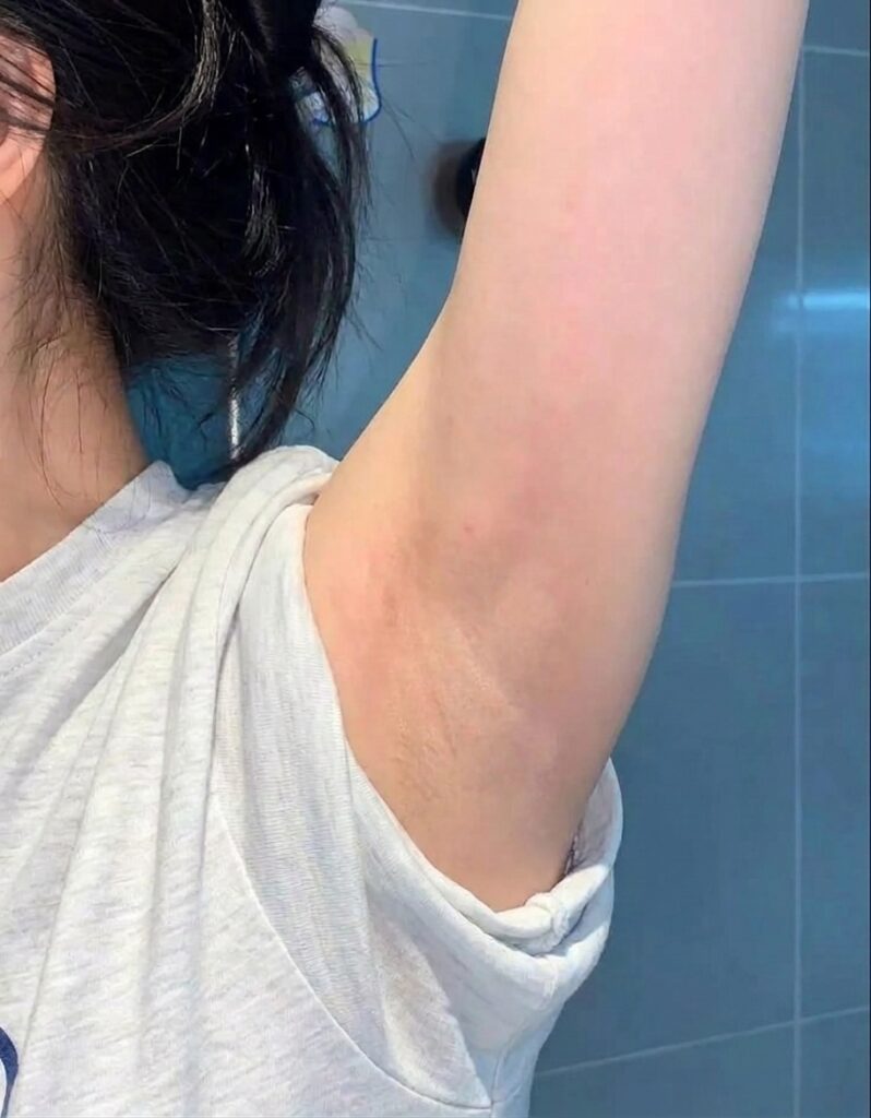 Clean, brightened underarm skin after Korean armpit whitening care