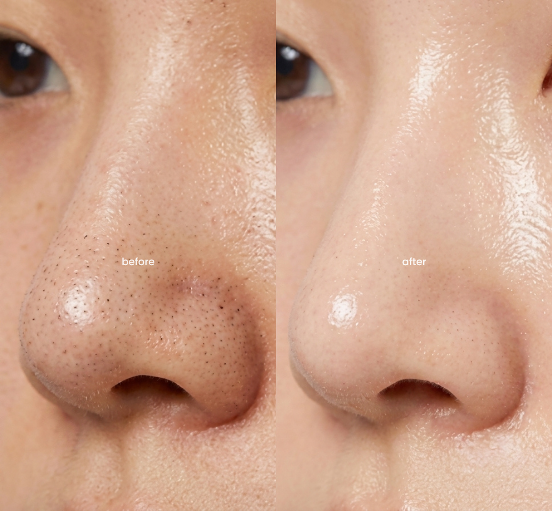 Before and after: blackhead and sebum removal on the nose